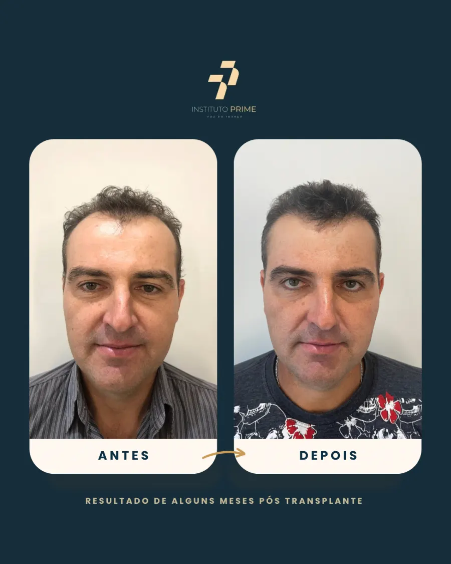 Antes e depois de transplante capilar com técnica FUE no Instituto Prime Foz do Iguaçu - paciente 1