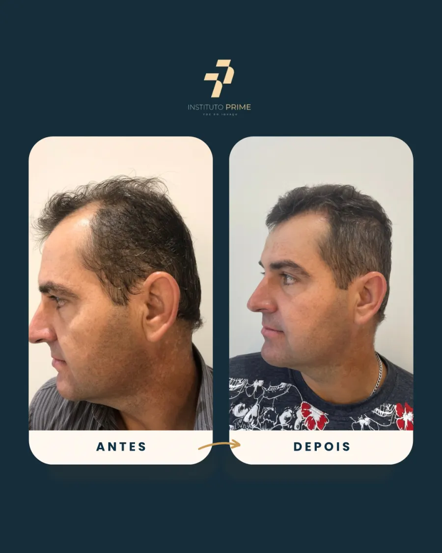 Antes e depois de transplante capilar com técnica FUE no Instituto Prime Foz do Iguaçu - paciente 2