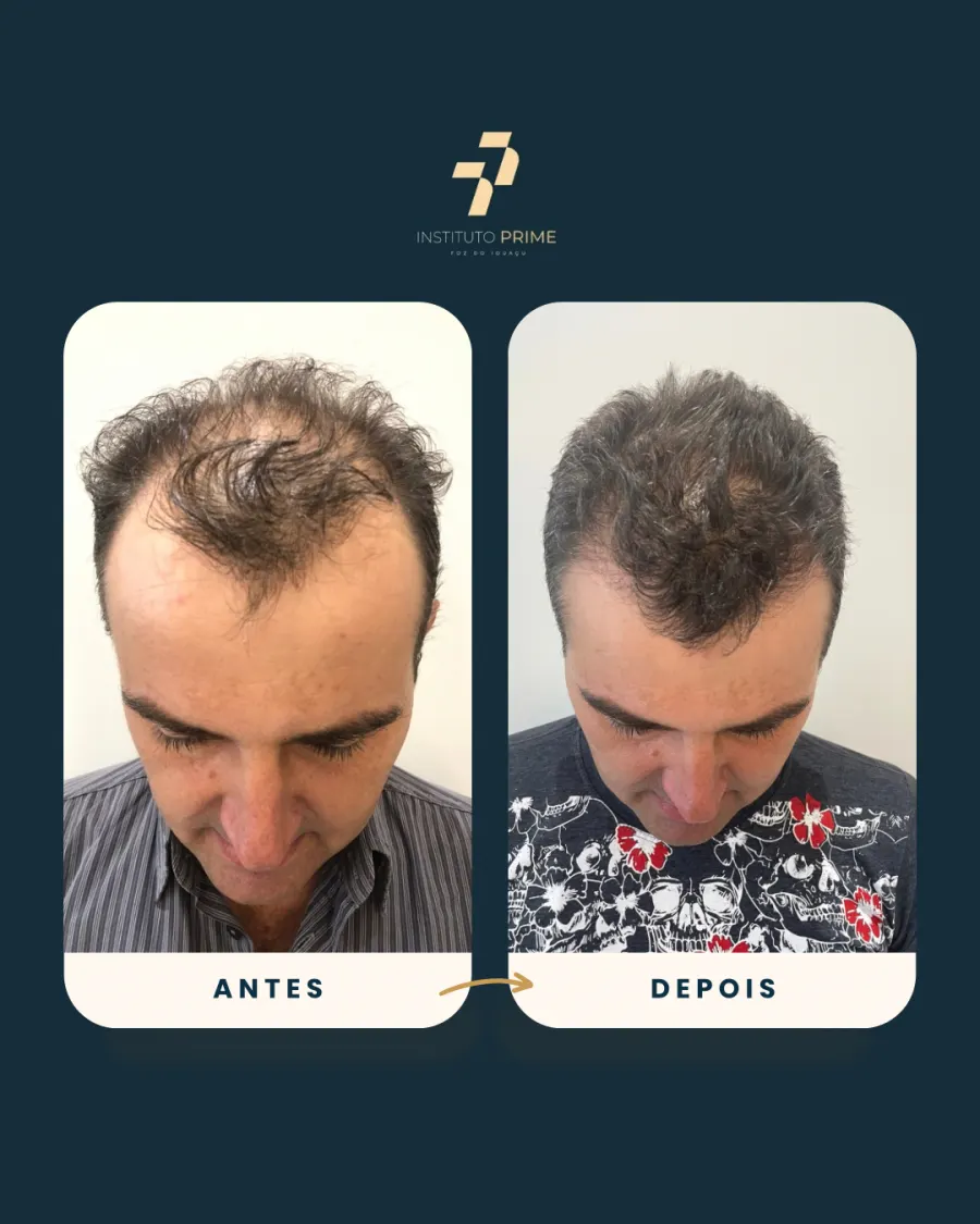 Antes e depois de transplante capilar com técnica FUE no Instituto Prime Foz do Iguaçu - paciente 3