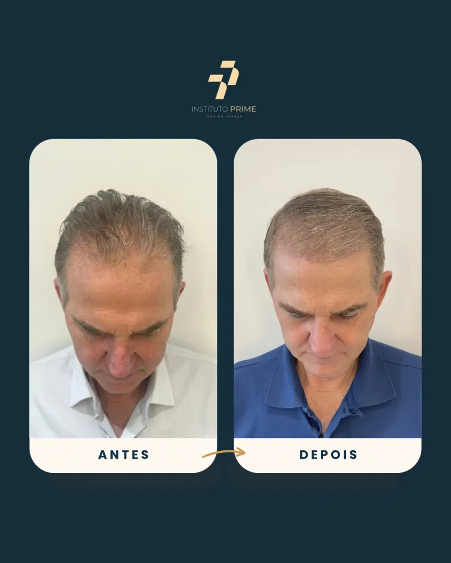 Antes e depois de transplante capilar com técnica FUE no Instituto Prime Foz do Iguaçu - paciente 4