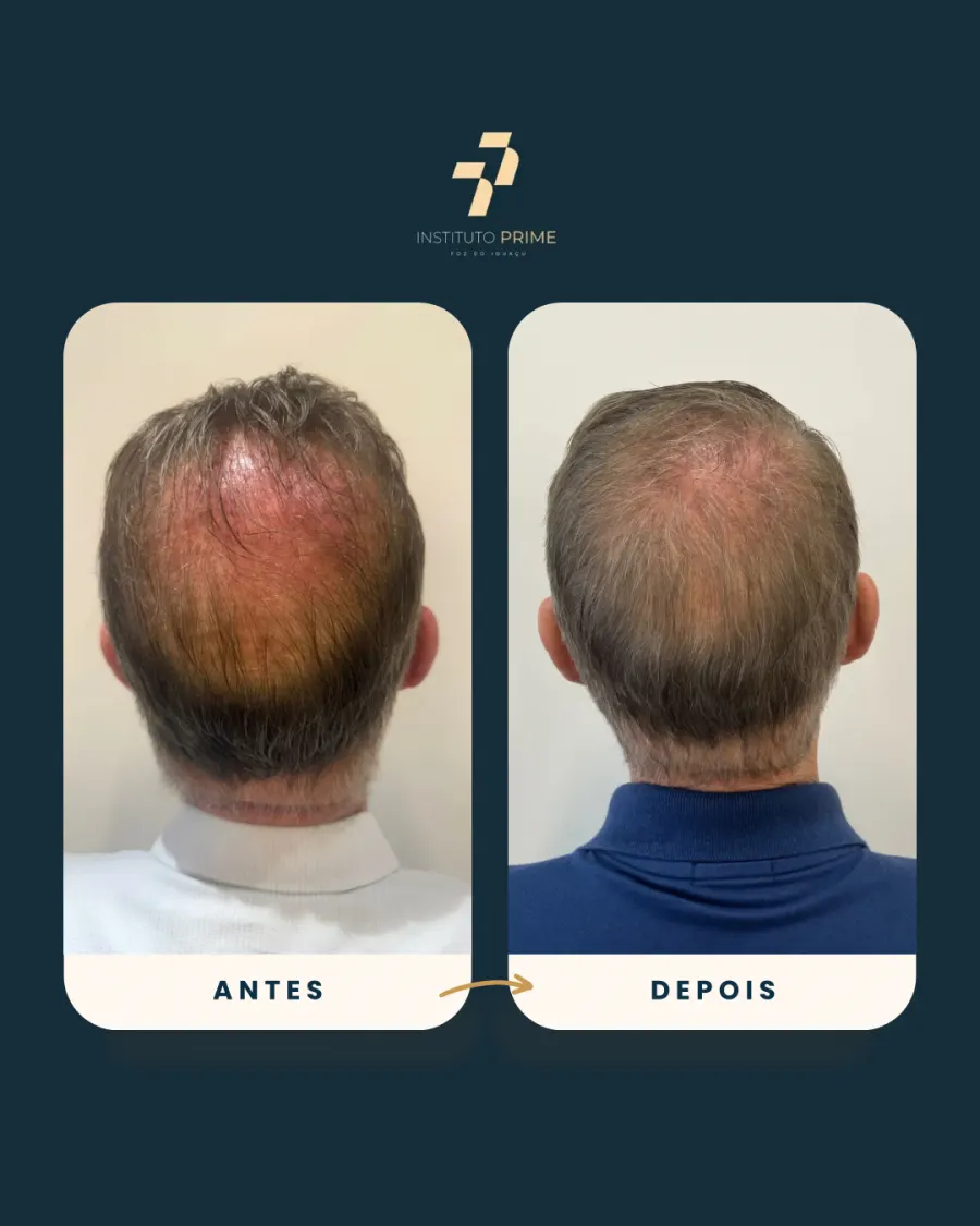 Antes e depois de transplante capilar com técnica FUE no Instituto Prime Foz do Iguaçu - paciente 5