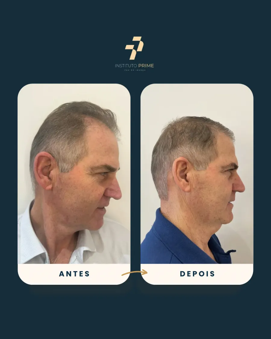 Antes e depois de transplante capilar com técnica FUE no Instituto Prime Foz do Iguaçu - paciente 6
