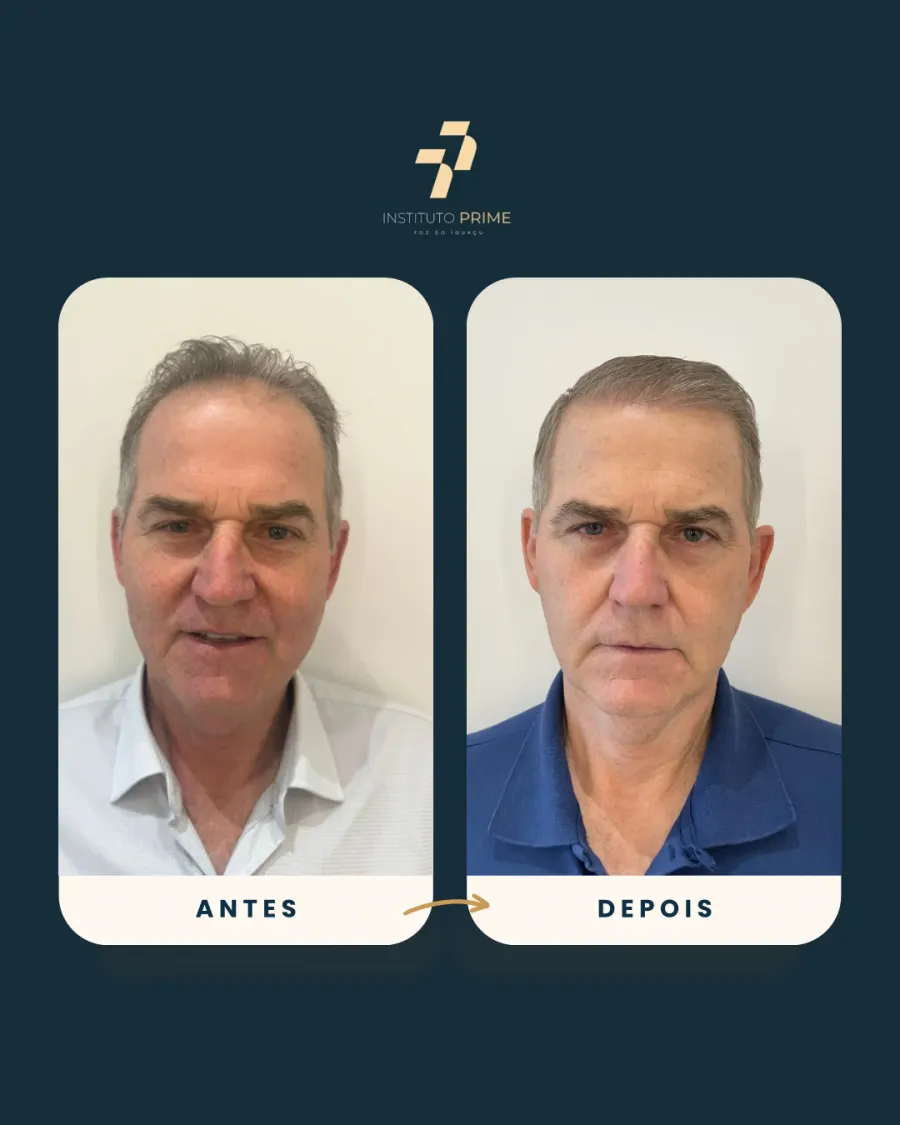 Antes e depois de transplante capilar com técnica FUE no Instituto Prime Foz do Iguaçu - paciente 7