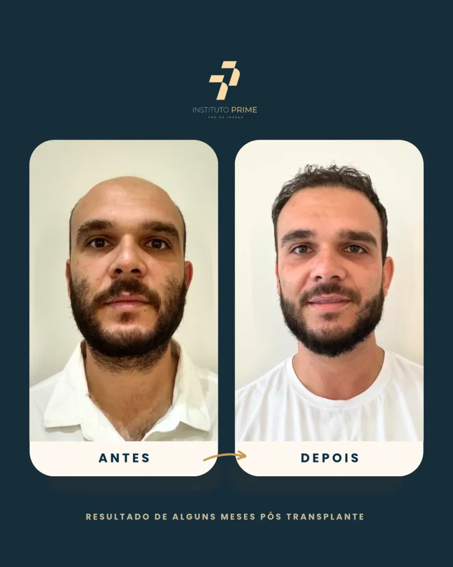 Antes e depois de transplante capilar com técnica FUE no Instituto Prime Foz do Iguaçu - paciente 8