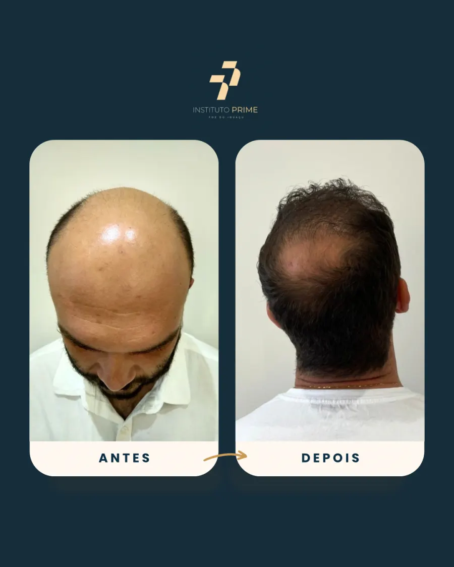 Antes e depois de transplante capilar com técnica FUE no Instituto Prime Foz do Iguaçu - paciente 9