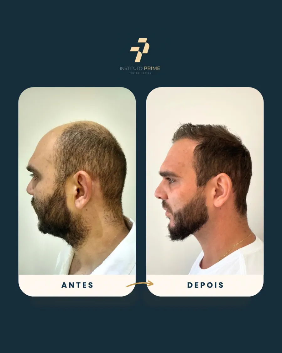 Antes e depois de transplante capilar com técnica FUE no Instituto Prime Foz do Iguaçu - paciente 10