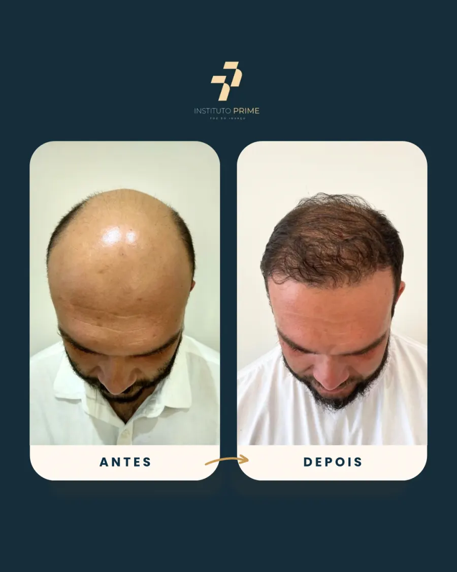 Antes e depois de transplante capilar com técnica FUE no Instituto Prime Foz do Iguaçu - paciente 11