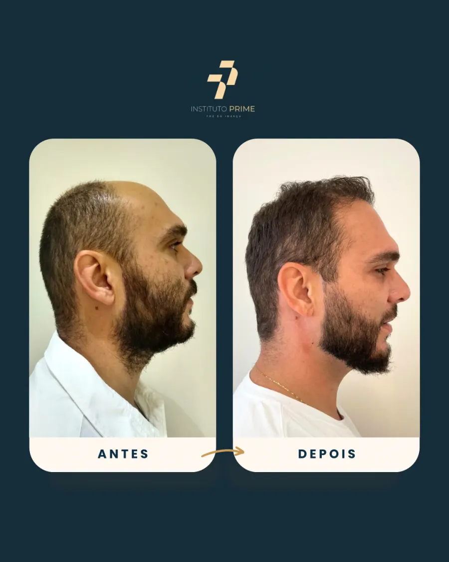 Antes e depois de transplante capilar com técnica FUE no Instituto Prime Foz do Iguaçu - paciente 12