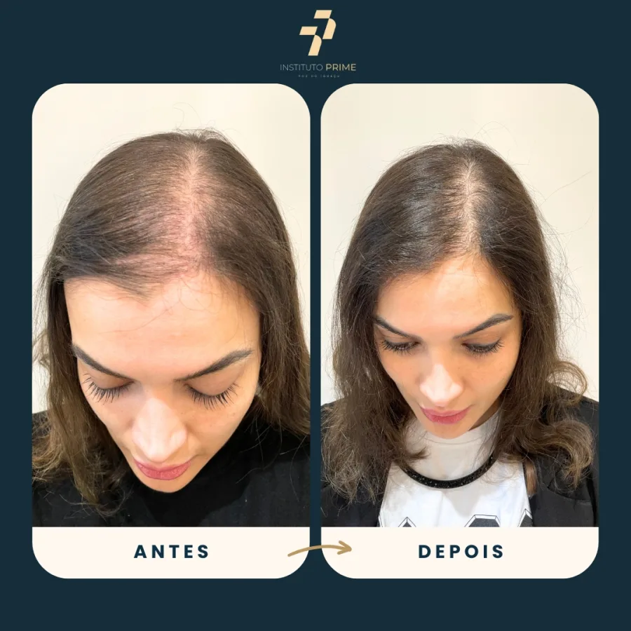 Antes e depois de transplante capilar com técnica FUE no Instituto Prime Foz do Iguaçu - paciente 13