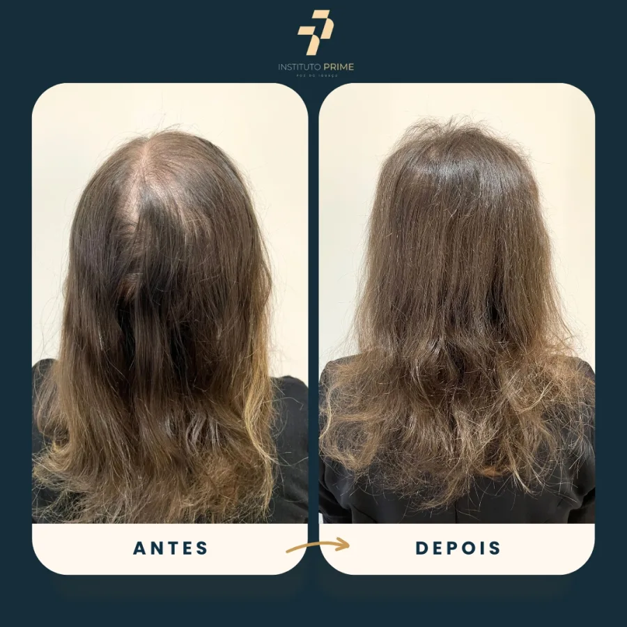 Antes e depois de transplante capilar com técnica FUE no Instituto Prime Foz do Iguaçu - paciente 15