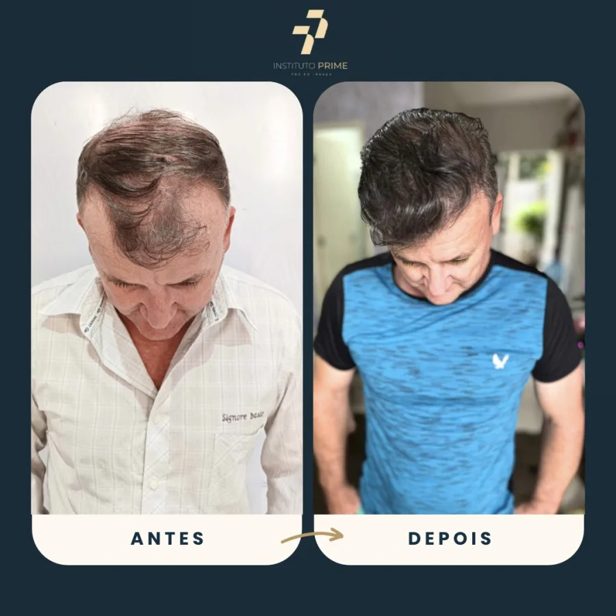Antes e depois de transplante capilar com técnica FUE no Instituto Prime Foz do Iguaçu - paciente 17