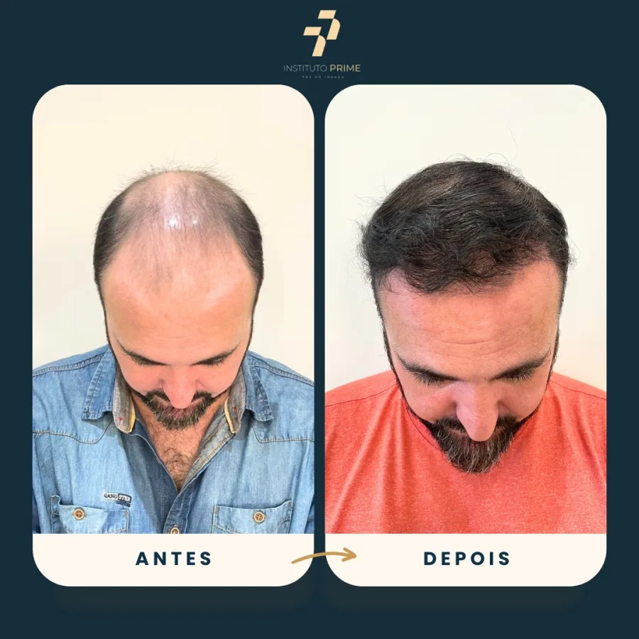 Antes e depois de transplante capilar com técnica FUE no Instituto Prime Foz do Iguaçu - paciente 18