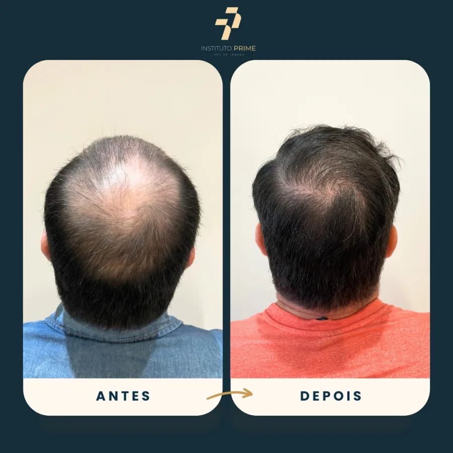 Antes e depois de transplante capilar com técnica FUE no Instituto Prime Foz do Iguaçu - paciente 19