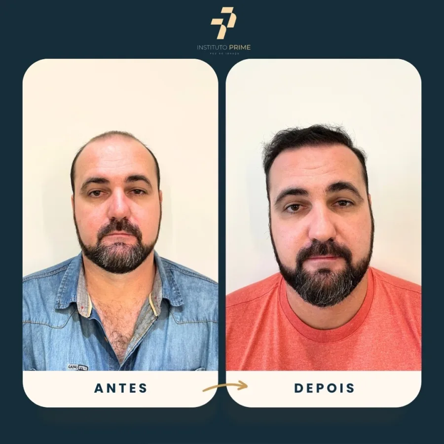 Antes e depois de transplante capilar com técnica FUE no Instituto Prime Foz do Iguaçu - paciente 20